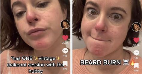 Women Are Speaking Up About Chin Infections From Kissing Their Bearded Partners So We Spoke To ...