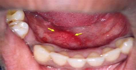 Sublingual gland - Operative Techniques in Otolaryngology-Head and Neck Surgery