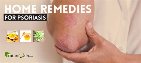 10 Best Home Remedies for Psoriasis that Work [Naturally]