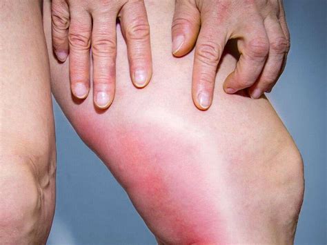 Phlebitis: 10 Symptoms Of Phlebitis