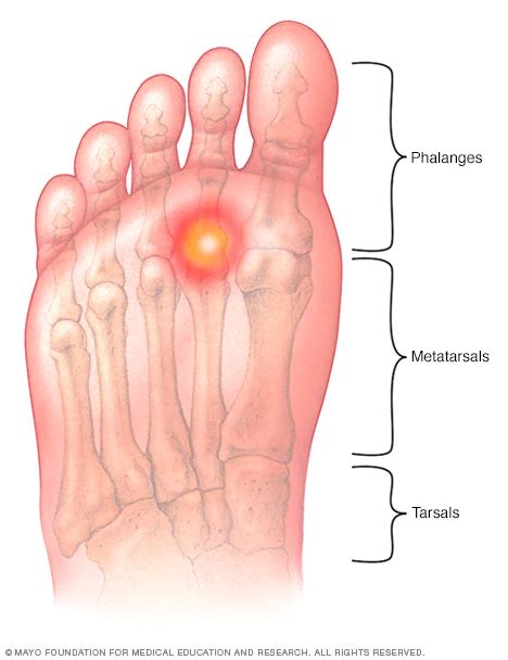 Metatarsalgia symptoms and causes – Artofit