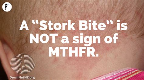 A “Stork Bite” is NOT a sign of MTHFR - Naturopathic Pediatrics