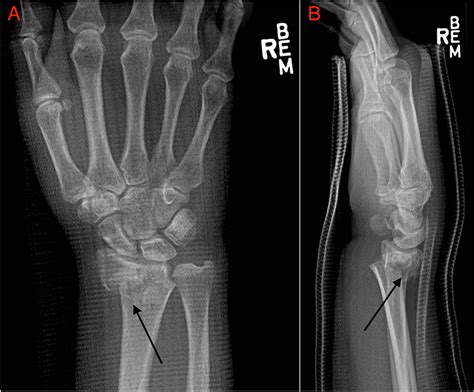 A Hematoma Block in the Wrist for a Displaced Distal Radius Fracture Induces Systemic ...