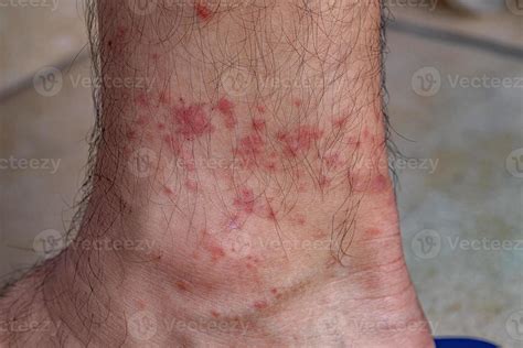 allergic reactions to tick bites 9230508 Stock Photo at Vecteezy