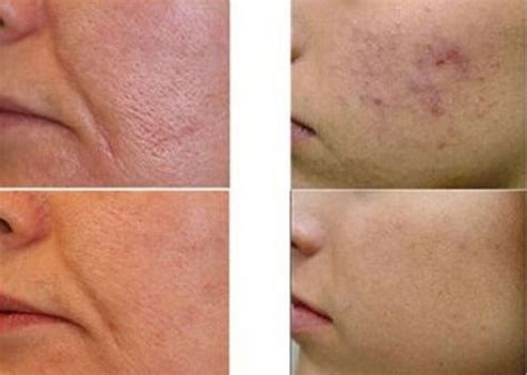 Laser scar removal: how many procedures do you need - Coolaser Clinic