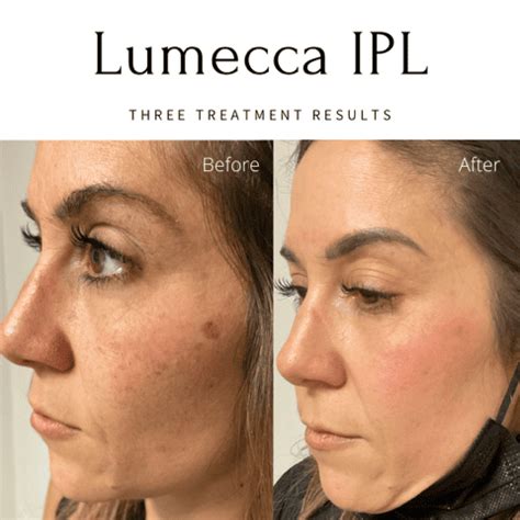 Lumecca IPL Before & After Images | EMME Skin Studio