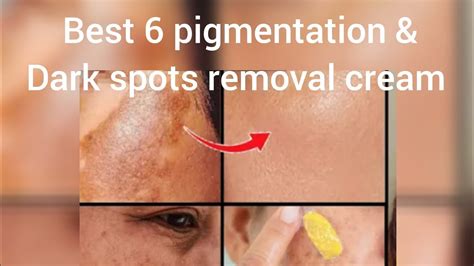 best 6 pigmentation &Dark spots removal creams.Top 6 creams for ...