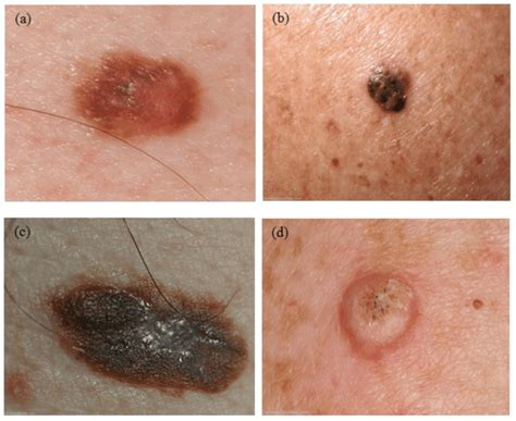 Melanoma Skin Cancer Lesions