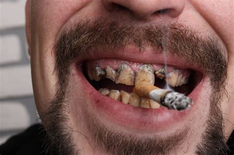 What Tobacco Does to Your Oral Health | Birch Point Dental Clinic ...