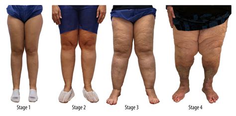 American Journal of Case Reports | Lipedema Can Be Treated Non ...