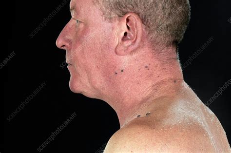 Blue rubber bleb nevus syndrome - Stock Image - C025/9626 - Science ...