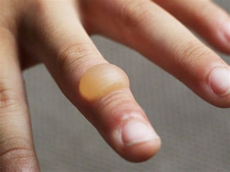 How to recognize and treat a burn blister | Лечение, Полезные советы, Пораженный
