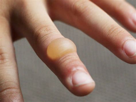 How to recognize and treat a burn blister | Лечение, Полезные советы ...