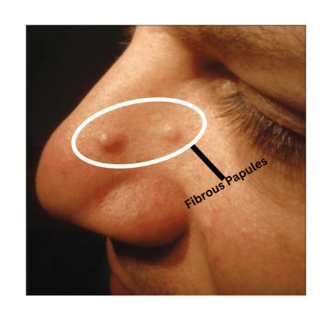 Fibrous Papule On Nose | Causes, Diagnosis, And Treatments