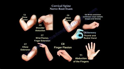 C7 8 nerve root compression