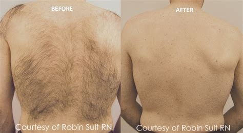 Laser Hair Removal for Men Calgary - Revive Laser