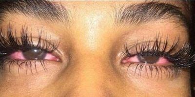 How To Get Rid Of Red Eyes From Weed : In a few weeks i am going to smoke weed and get high for ...