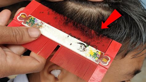 Extremely severe head lice removal - YouTube