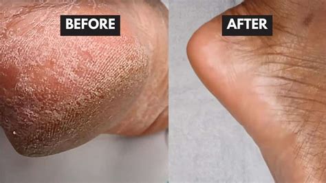 How to Remove Dead Skin Cells From Your Feet in Minutes