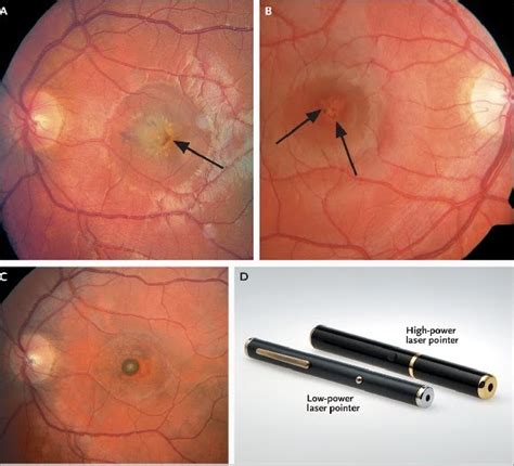 Eye Doctors Warn of Retinal Injuries From High-Powered Green Lasers – Impact Lab