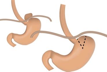 Collis Gastroplasty in Short Esophagus Reduces Recurrence Of Hiatal Hernia