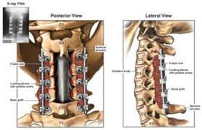 Surgical Treatment - SpineMD