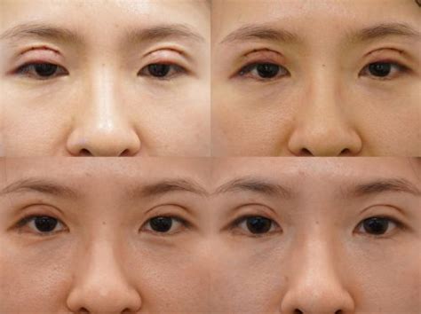 Review: Double Eyelid Surgery Done in Singapore - With Love,