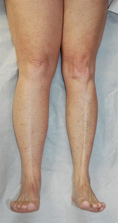 Lymphedema Surgery