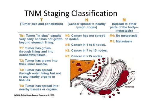 Gastric cancer - Oncology Nurse Advisor