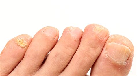 Toenail Fungus: Signs, Causes and Cure