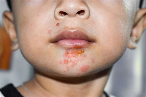 Impetigo Bulosa