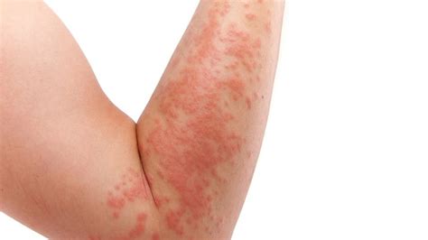 Hives: Types, Causes, Symptoms, Diagnosis and Treatment