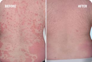 Psoriasis Before & After Pictures | SKYRIZI® (risankizumab‐rzaa)