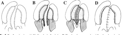 Figure 3 from Palatoplasty: evolution and controversies. | Semantic Scholar