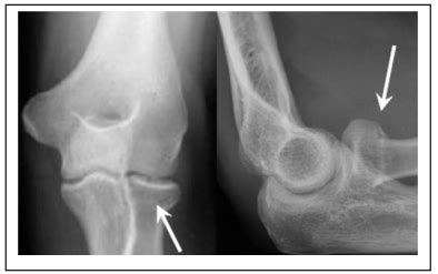 Radial Head / Neck Fracture — Chelsea and Westminster Hospital NHS Foundation Trust