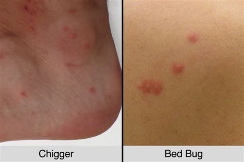 Difference Between Chigger Bites And Bed Bug Bites - PestPhobia