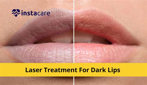 Laser Treatment For Dark Lips - All You Need To Know