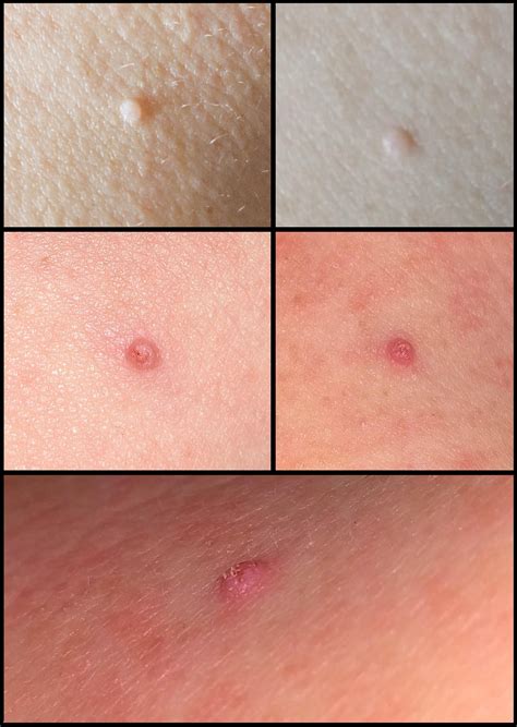 Itchy Red Bumps On Skin | Images and Photos finder