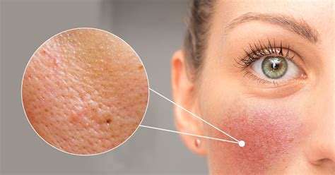 Understanding the Causes of Orange Peel Skin