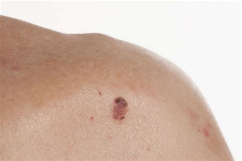 What Does Skin Cancer Look Like?