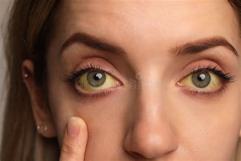 Woman Checking Her Health Condition, Closeup. Yellow Eyes As Symptom of Problems with Liver ...