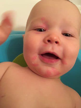 Baby Egg Allergy Rash Pictures - Get More Anythink's