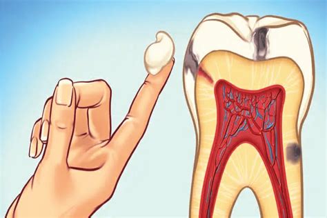 Toothache Symptoms, Causes, and Treatments | Dental Depot