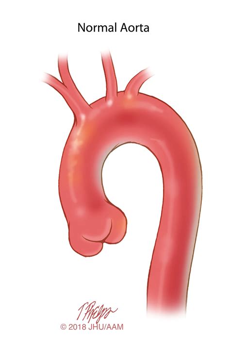 Adult Congenital Aortic Syndrome | Johns Hopkins Medicine