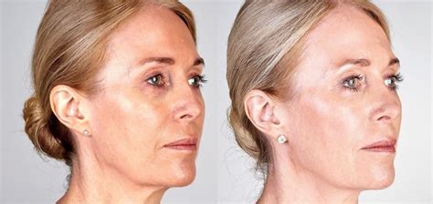 Skin Tightening Procedures For Face