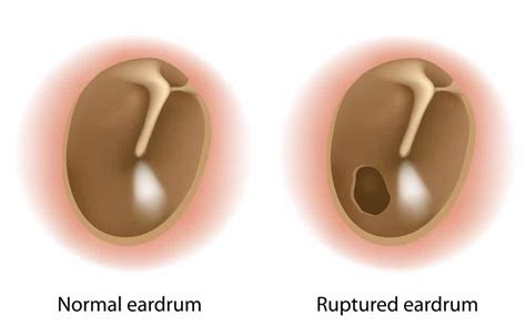 Ear Infection Ear Hole at David Roberts blog