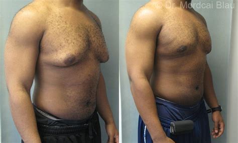 Severe Gynecomastia