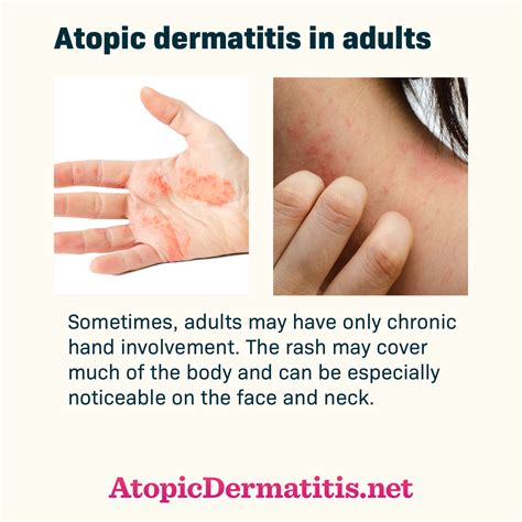 Dermatitis Rash Description