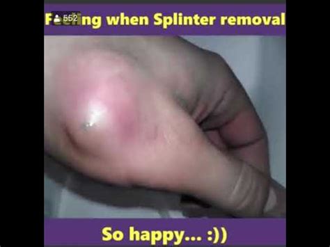 Splinter removal - YouTube