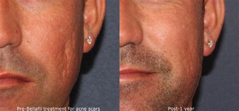 Acne Scars San Diego, CA | Cosmetic Laser Dermatology